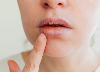 Cum să previi răspândirea herpesului în familie și la cei apropiați?